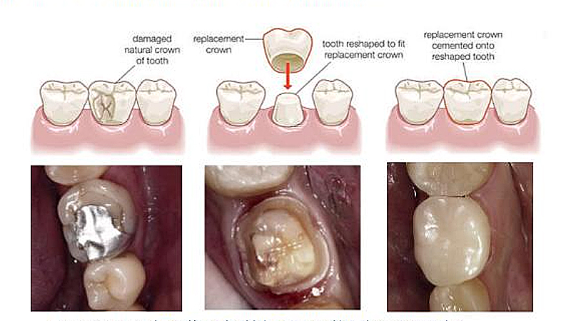How Long Is A Dental Crown Procedure Detroit Chinatown How Long Is A Dental Crown Procedure Detroit Chinatown